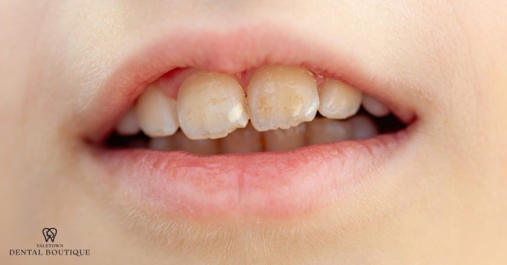 Teeth showing visible white and light brown spots on the enamel, characteristic of dental fluorosis.