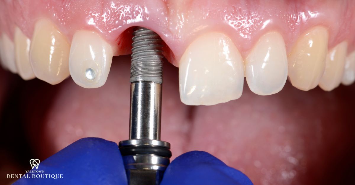 Close-up of front tooth dental implant being placed to illustrate steps that reduce implant risks