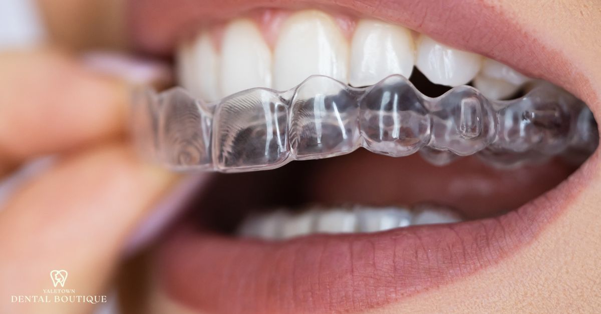 Patient placing a clear Invisalign aligner over teeth, highlighting the advantages of Invisalign.