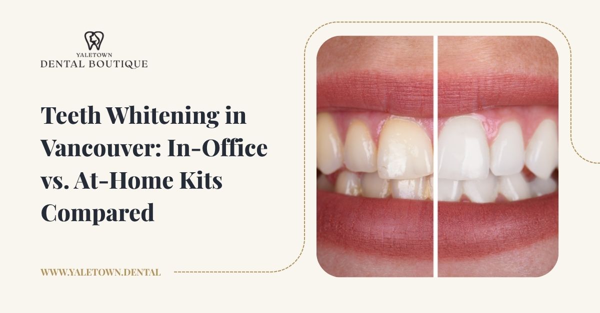 Teeth Whitening in Vancouver: In-Office vs. At-Home