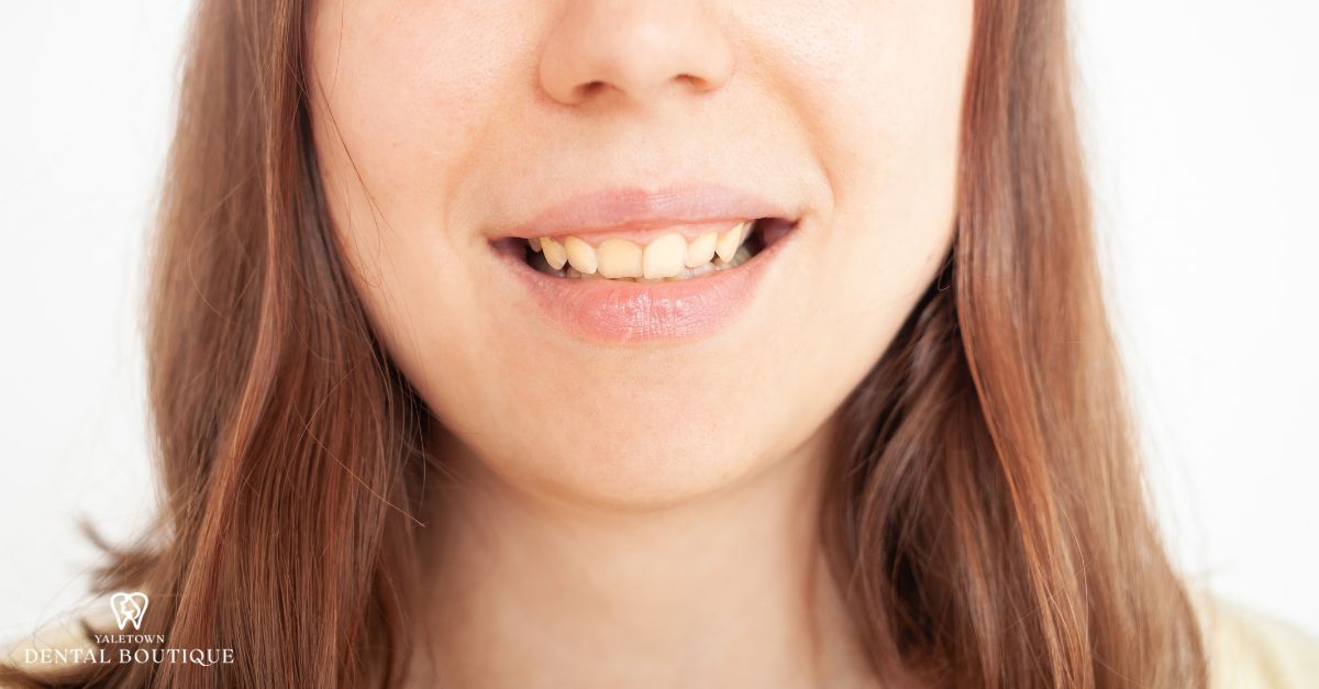 A person's natural smile showing slightly yellowed teeth
