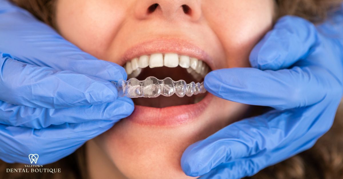 Invisalign aligner being positioned on a patient’s teeth, demonstrating suitability for clear aligner treatment.