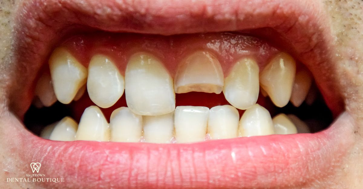 cracked and broken tooth that need emergency care