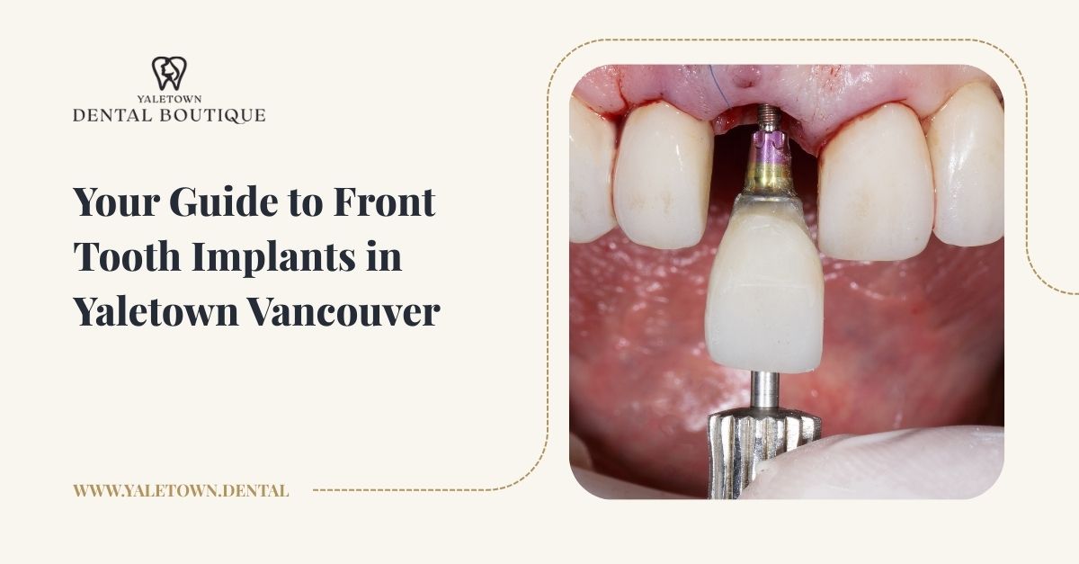Your Step-by-Step Guide to Front Tooth Implant in Vancouver