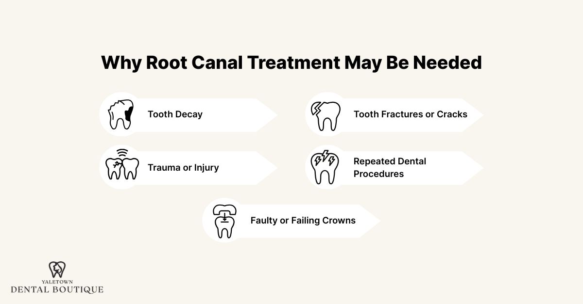 Why Root Canal Treatment May Be Needed