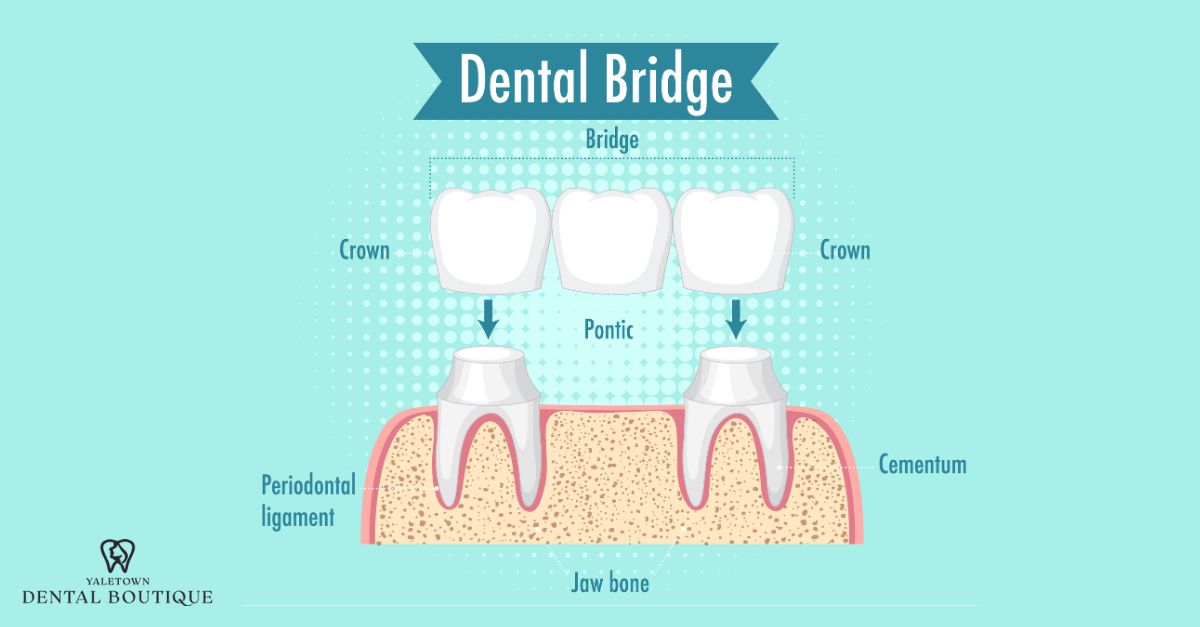 Illustration of dental bridge and its components.