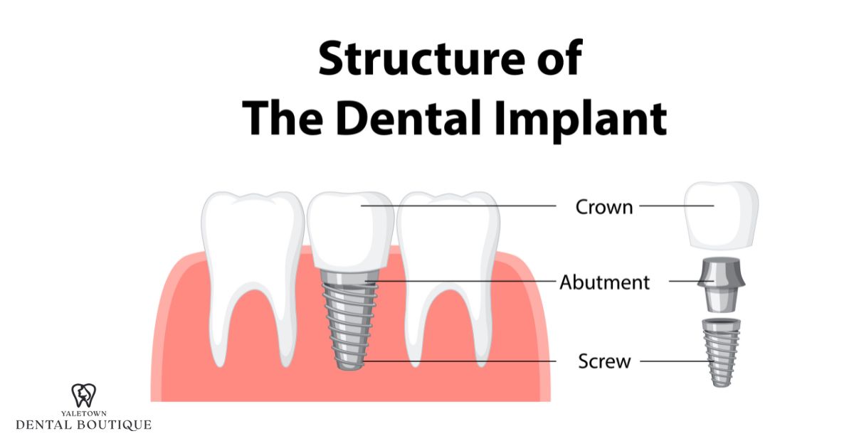 Illustration of dental bridge and its components