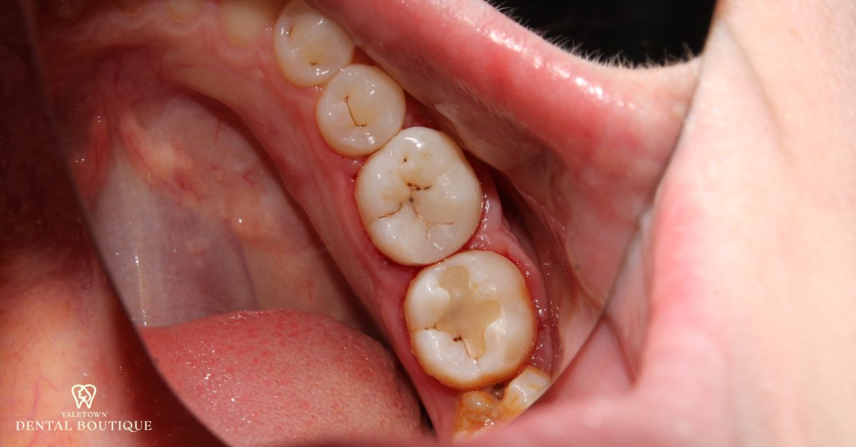 Patient’s lower teeth with stained composite fillings visible on back molars.