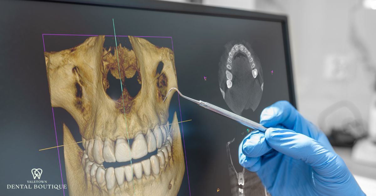 CBCT Scan in Dentistry | 3D Imaging in Vancouver