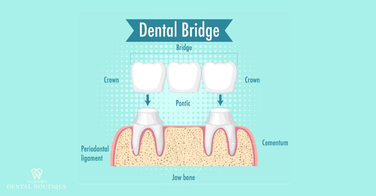 Graphic depiction of a dental bridge and its components
