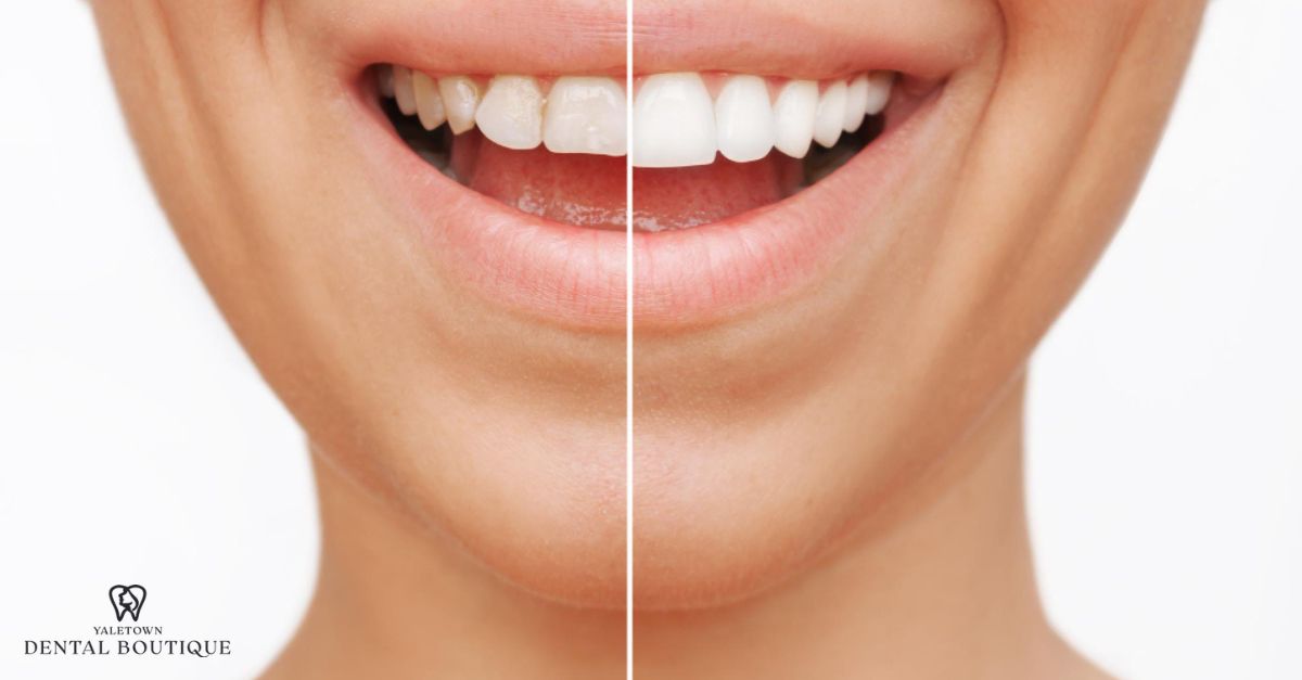 efore and after smile comparison highlighting the difference between Lumineers and veneers in cosmetic dentistry.