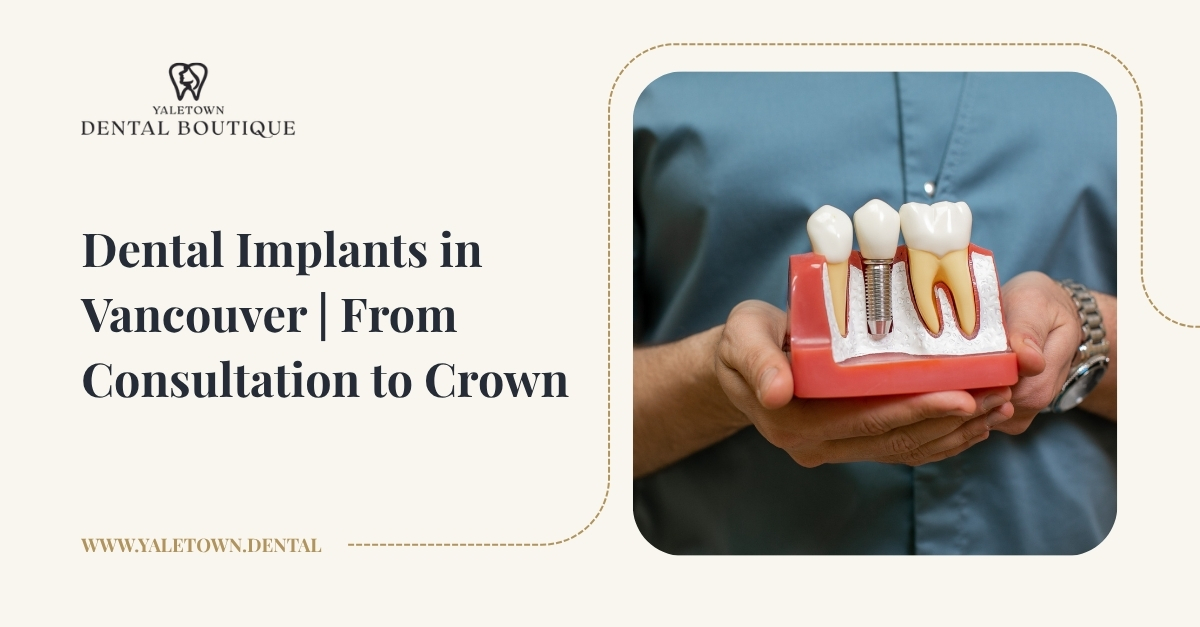 Dental Implants in Vancouver | From Consultation to Crown