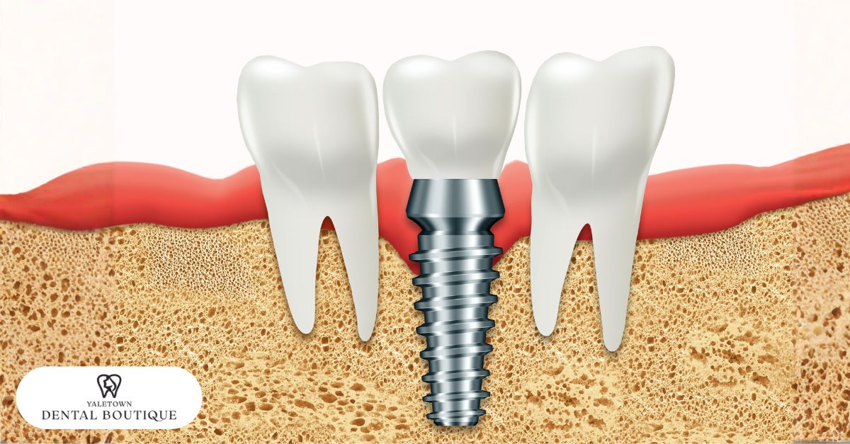 Osseointegration phase of dental implant recovery where the titanium post bonds with surrounding bone.
