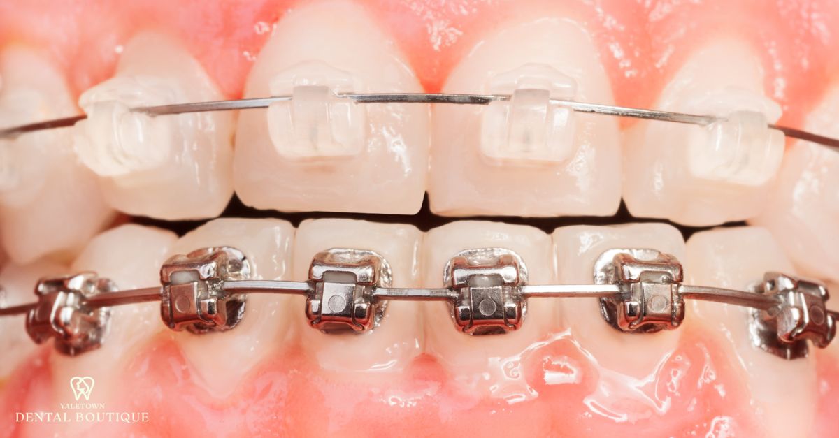 Clear braces offering a discreet, aesthetic alternative to metal braces.