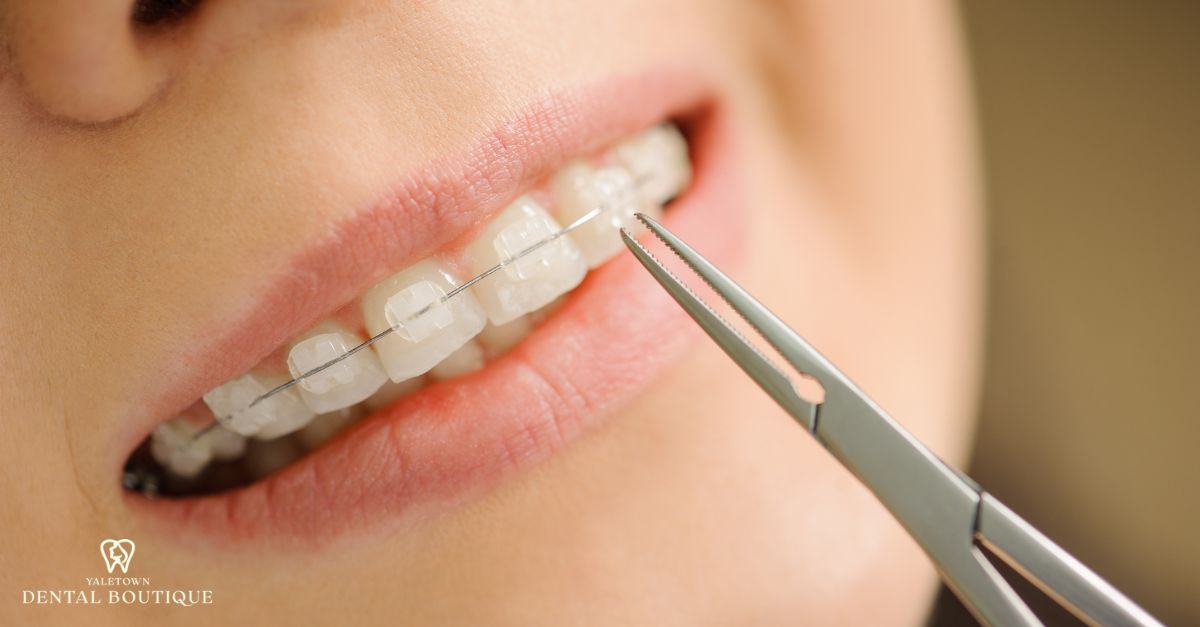 Clear braces being adjusted during orthodontic treatment, showing a discreet and effective teeth-straightening option.