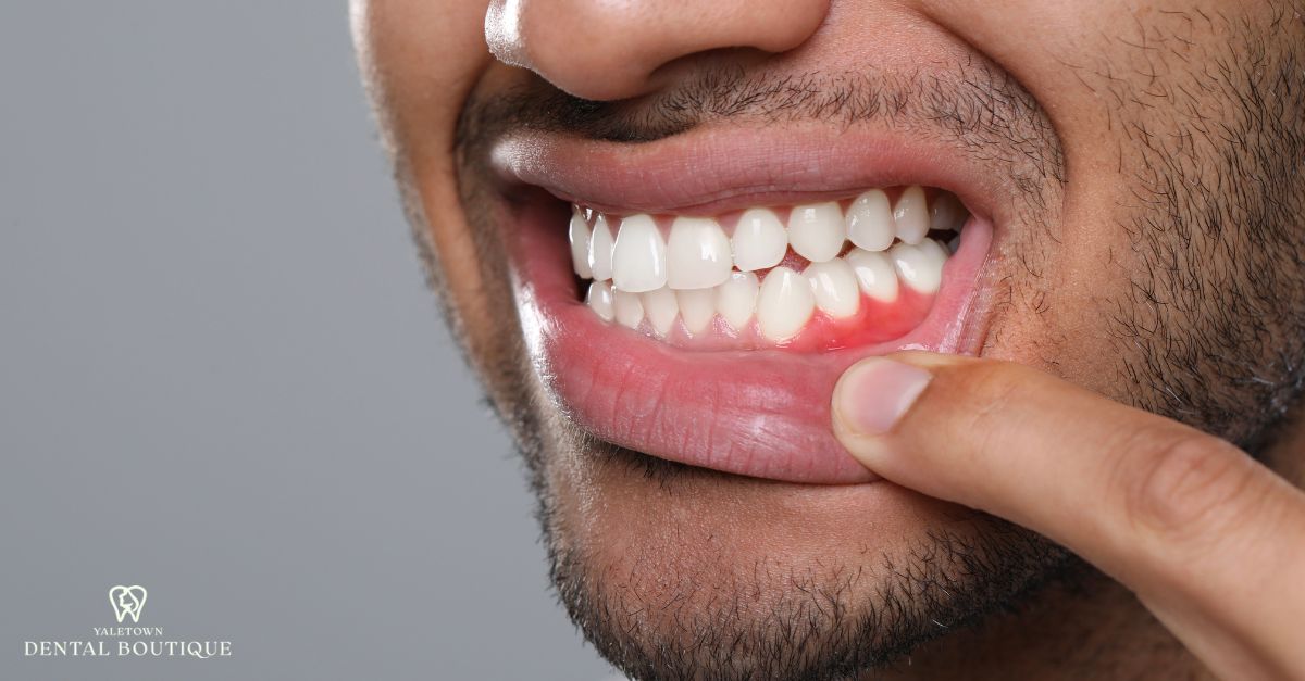 Gum disease causing loose teeth, shown by inflamed gums and early signs of tissue breakdown