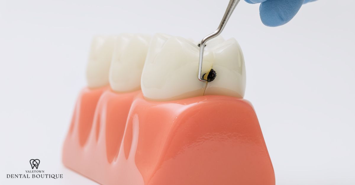  Close-up of crown pain cause, showing a cavity forming under the crown surface