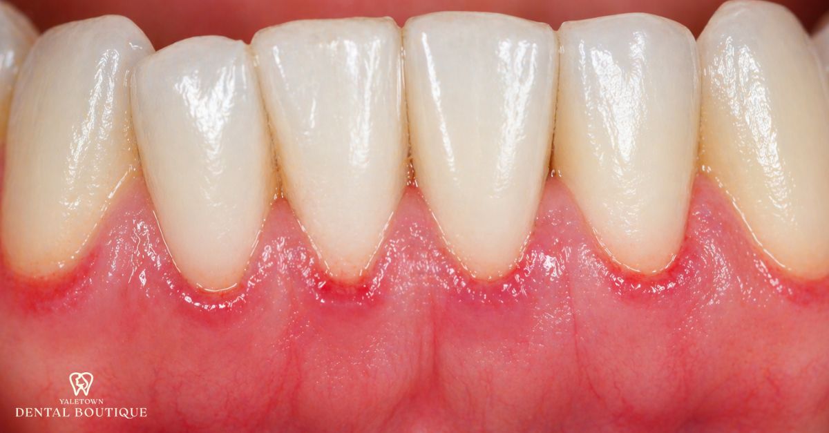 Close-up illustrating what gingivitis actually is, with early-stage irritation and slight swelling of the gums
