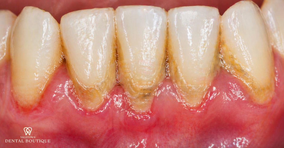Close-up illustrating why gingivitis develops, highlighting bacterial plaque accumulation and irritated gums