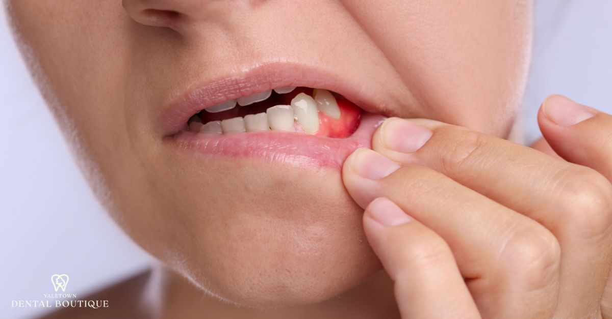 Close-up of a person pulling their lip to reveal red, swollen gums caused by bacterial buildup and inflammation