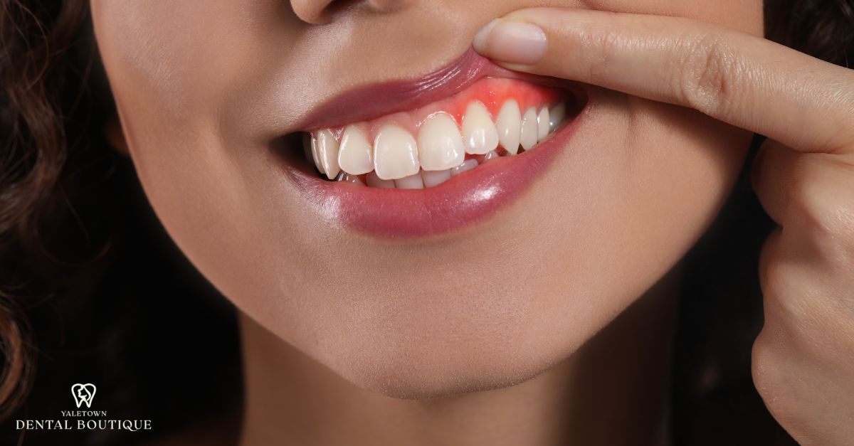 Close-up of a person lifting their lip to show gum recession with redness along the upper gumline 