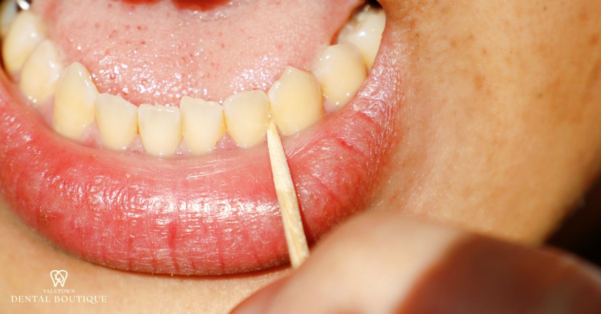  Food buildup between teeth that may indicate early dental concerns