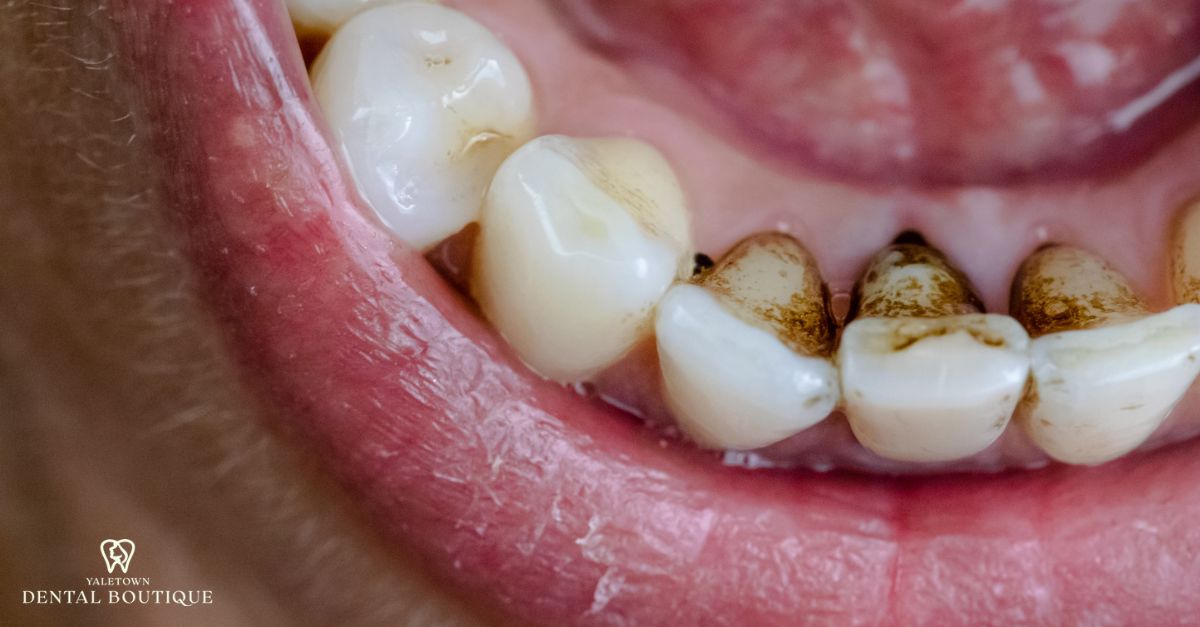 Dental model showing black spots on teeth with internal structure exposed