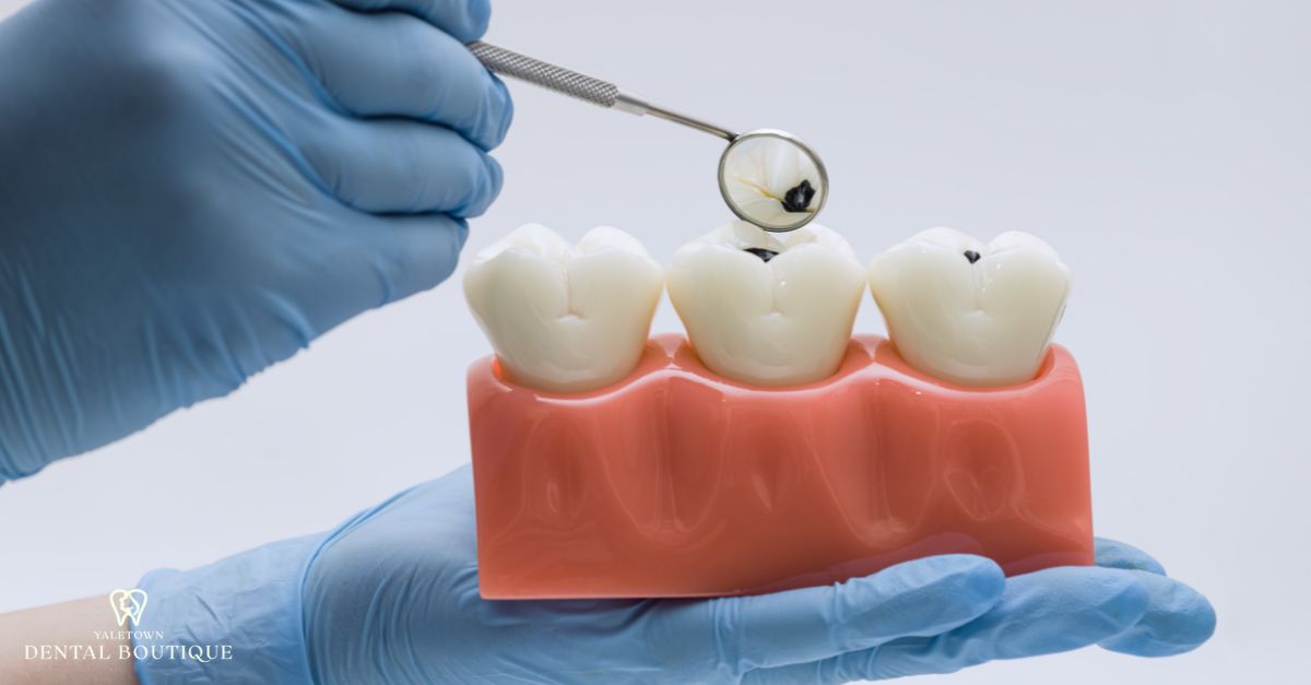 Dental model showing black spots in tooth grooves under examination